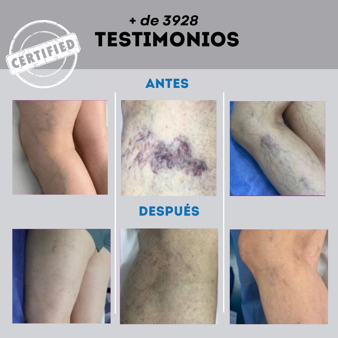 Spray para Várices – Alivio, Mejora la Circulación y Embellece tus Piernas 💆‍♀️✨